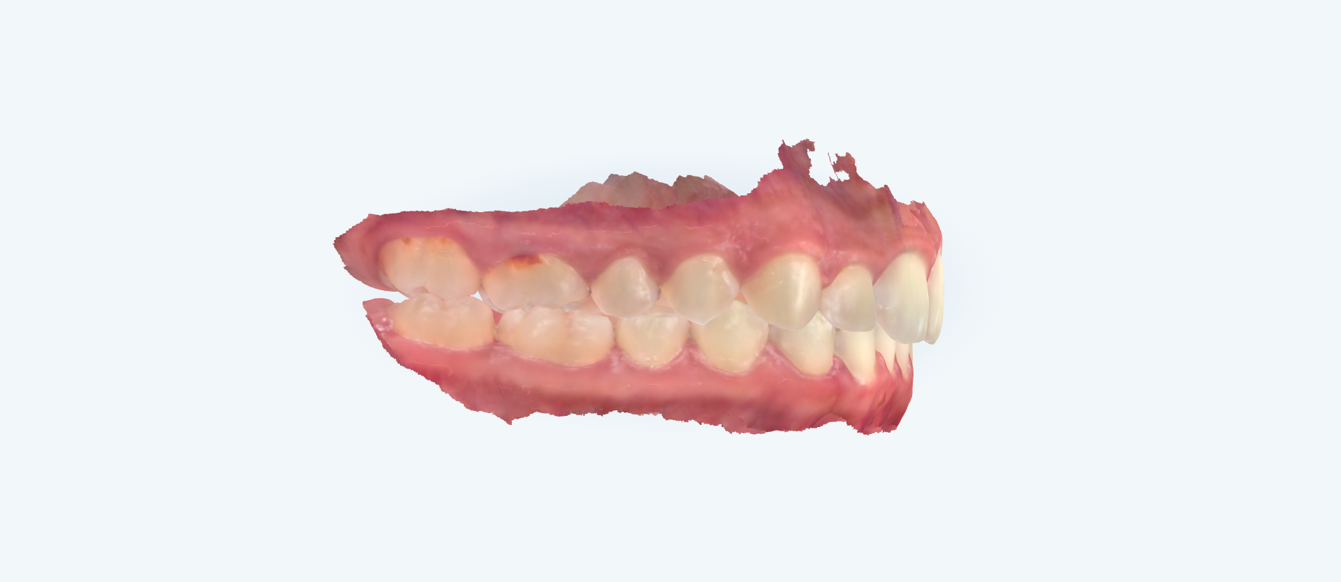 Overbite treatment comparison case 2 after